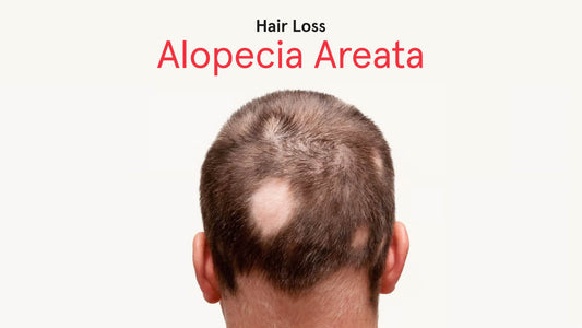 Alopecia Areata:  What Are The Signs & Treatments Available