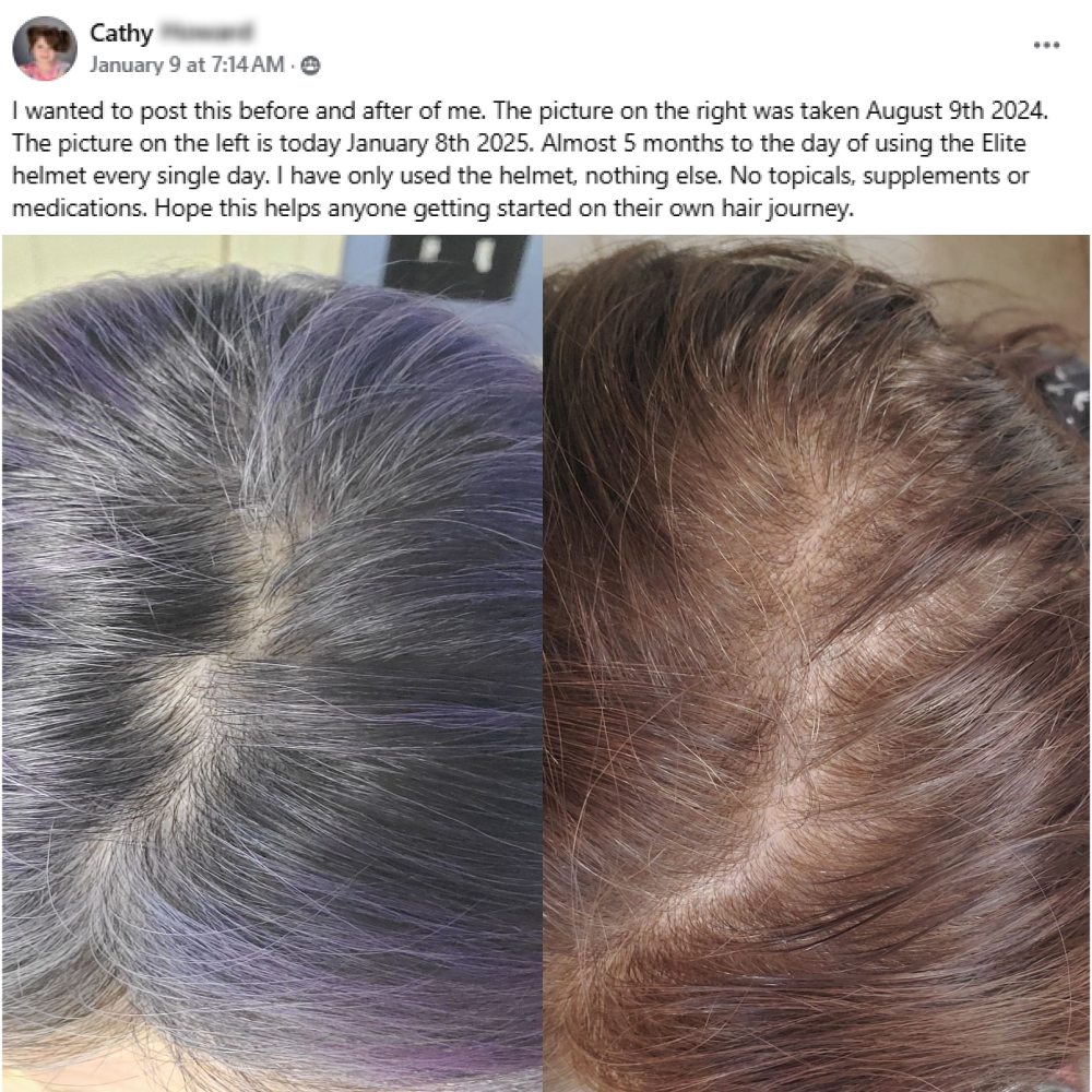 A facebook post from Cathy on January 9th 2025. I wnated to post this before and after of me. The picture on the right was taken August 9th 2024. The picture on the left is today January 8th 2025. Almost 5 months to the day of using the Elite helmet every single day. I have only used the helmet, nothing else. No topicals, supplements or medications. Hope this helps anyone getting started on their own hair journey.