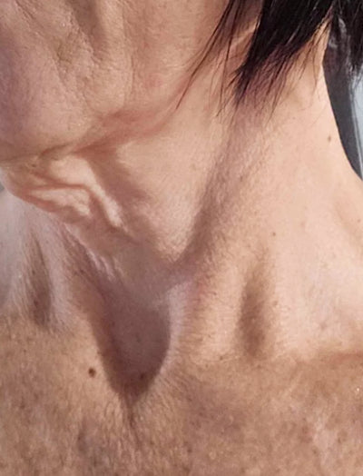 Before image of woman's neck with uneven skin tone and dark spots