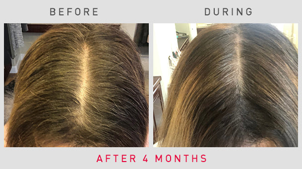 Before And After Photos Laser Hair Growth Therapy Irestore Reviews