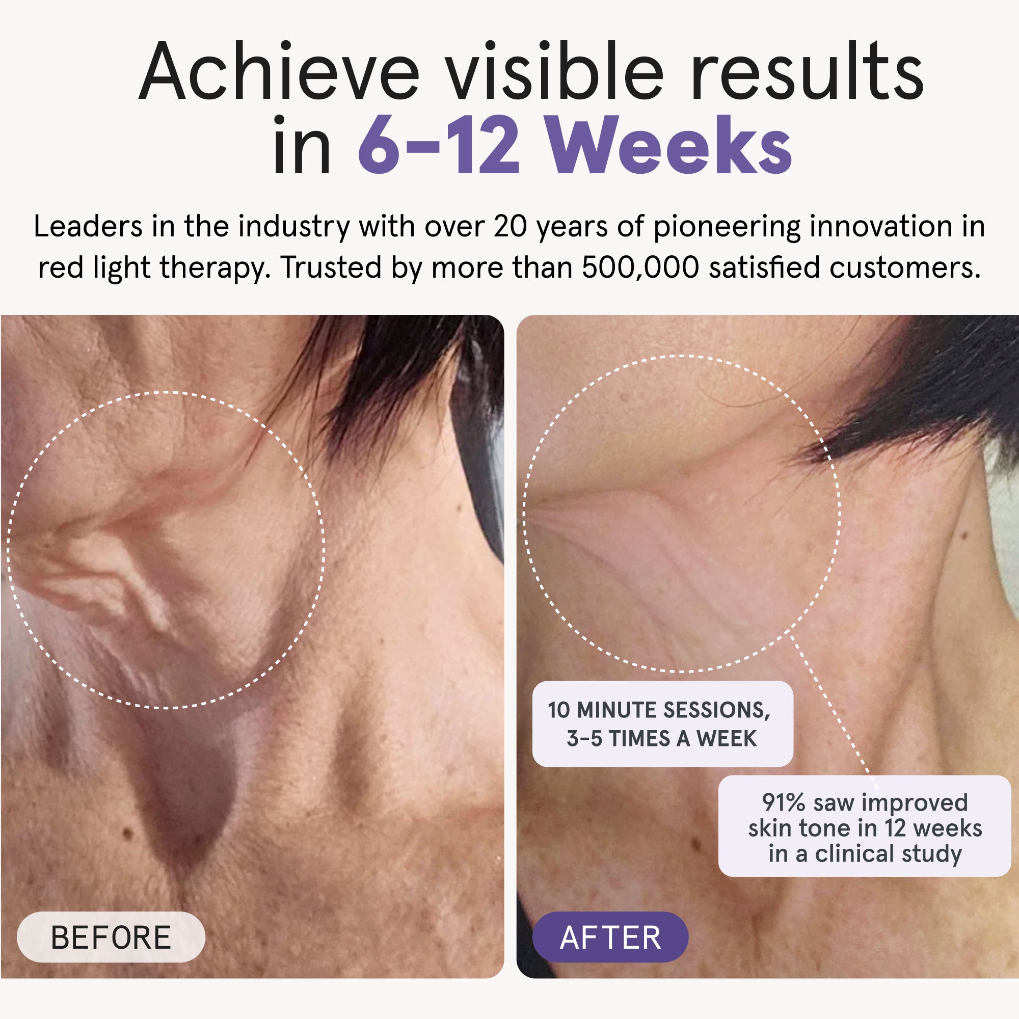 Side-by-side comparison of a woman’s profile showing visible improvements in neck skin firmness and reduced sagging after using the iRESTORE LED neck and chest mask for 6 to 12 weeks