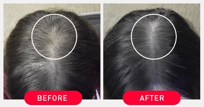iRestore Laser Hair Growth System | FDA-Cleared Hair Loss Treatment