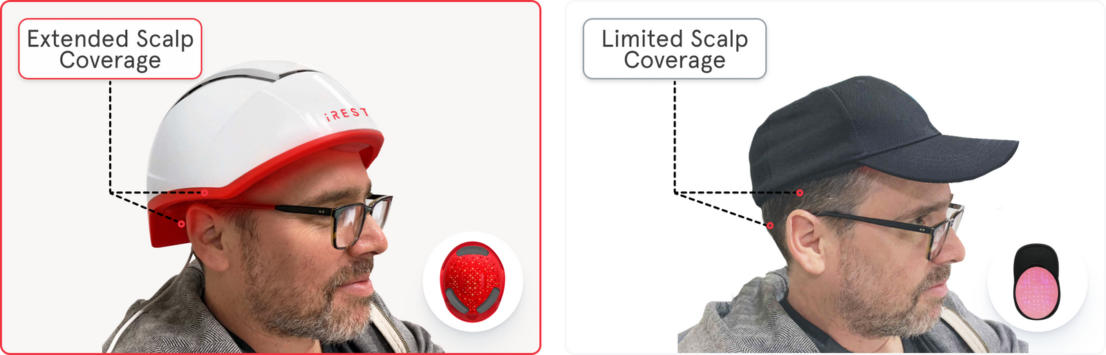 A side by side image comparing the coverage of iRESTORE compared to other laser cap. The left image shows the iRESTORE helmet with excellent scalp coverage. While the right image shows the other laser cap with limited scalp coverage.