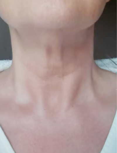 After image of woman's neck with reduced wrinkles and fine lines after 3 months of usage