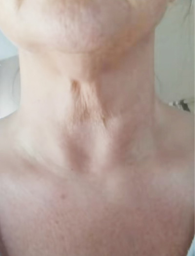 Before image of woman's neck with wrinkles and fine lines