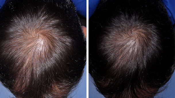 Irestore Laser Hair Growth System Fda Cleared Hair Loss Treatment